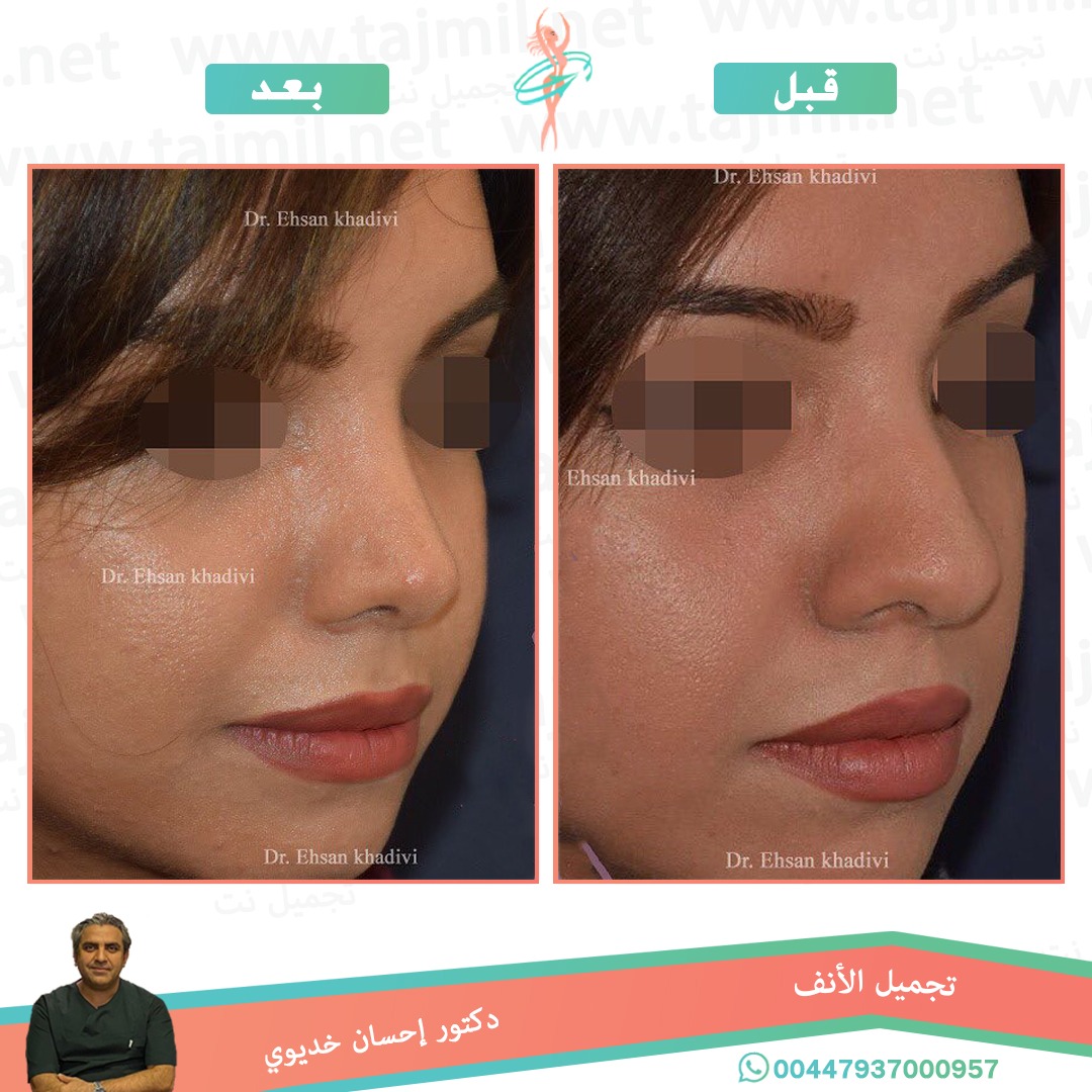  - دکتور إحسان خدیوي عملية تجميل الانف في ايران مع تجميل نت