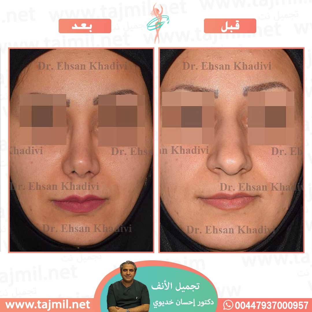  - دکتور إحسان خدیوي عملية تجميل الانف في ايران مع تجميل نت