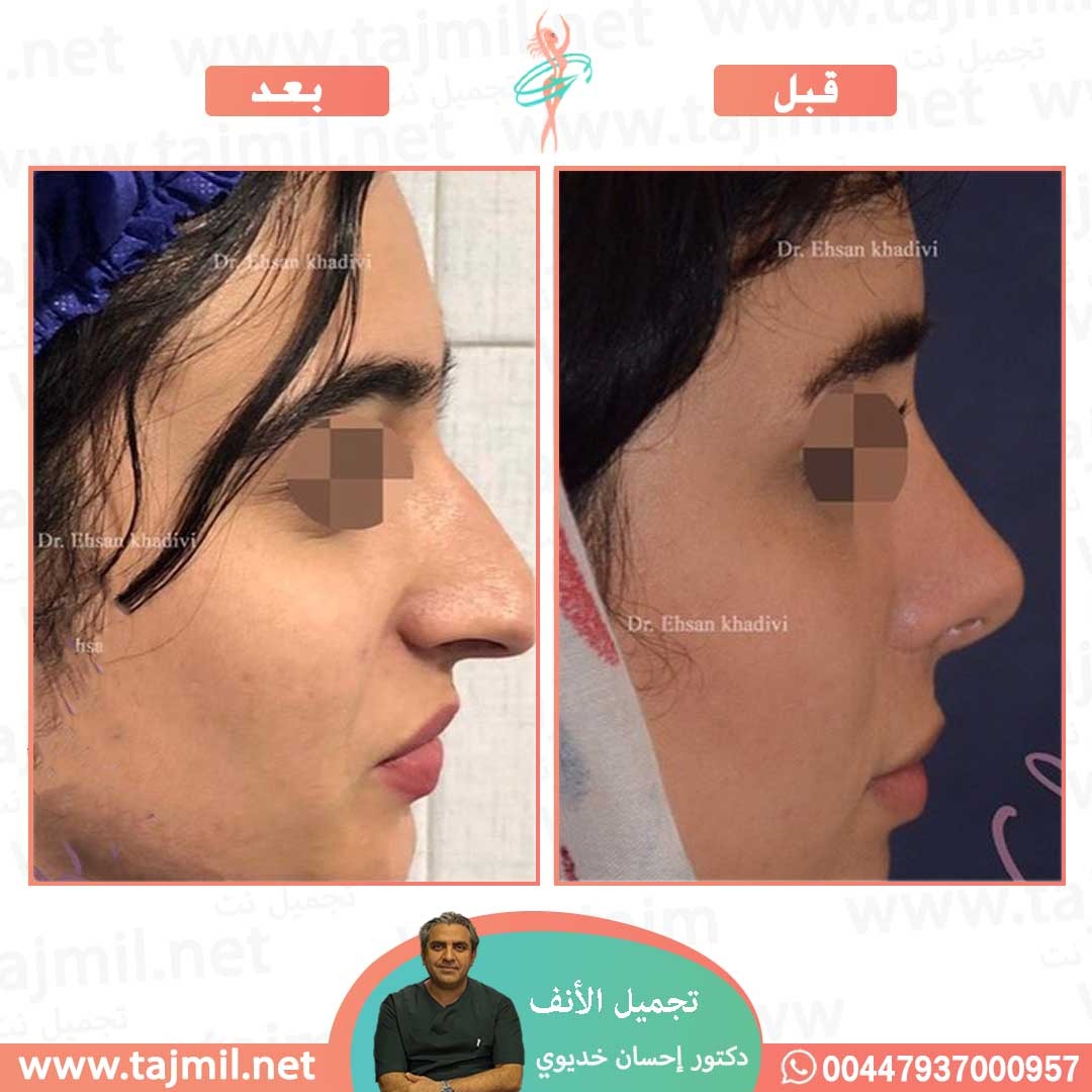  - دکتور إحسان خدیوي عملية تجميل الانف في ايران مع تجميل نت