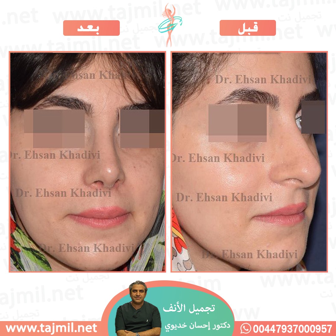  - دکتور إحسان خدیوي عملية تجميل الانف في ايران مع تجميل نت