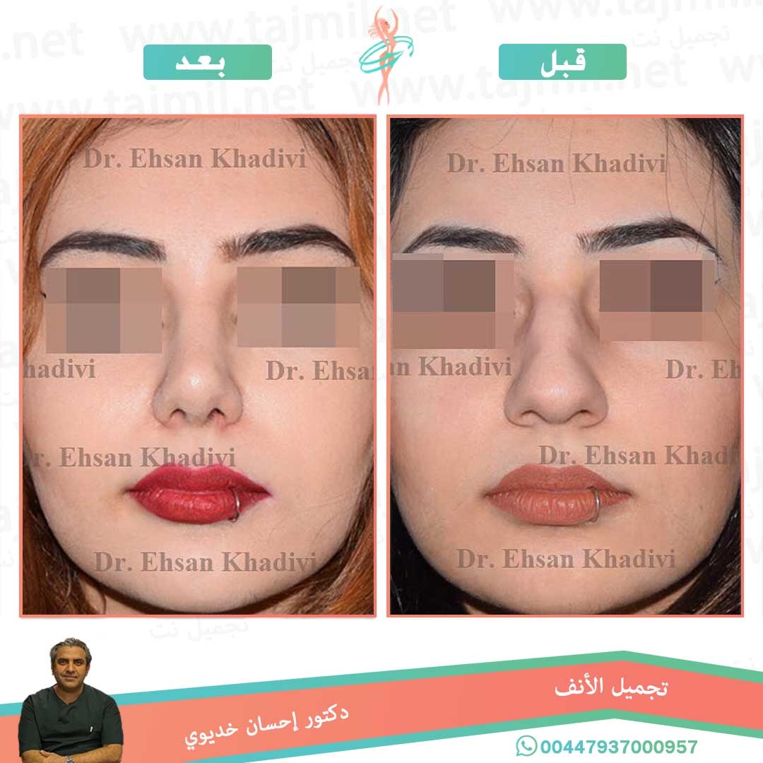  - دکتور إحسان خدیوي عملية تجميل الانف في ايران مع تجميل نت