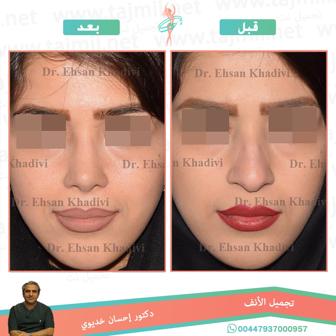  - دکتور إحسان خدیوي عملية تجميل الانف في ايران مع تجميل نت