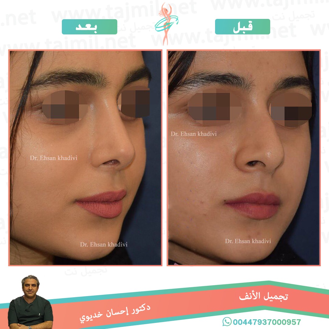  - دکتور إحسان خدیوي عملية تجميل الانف في ايران مع تجميل نت