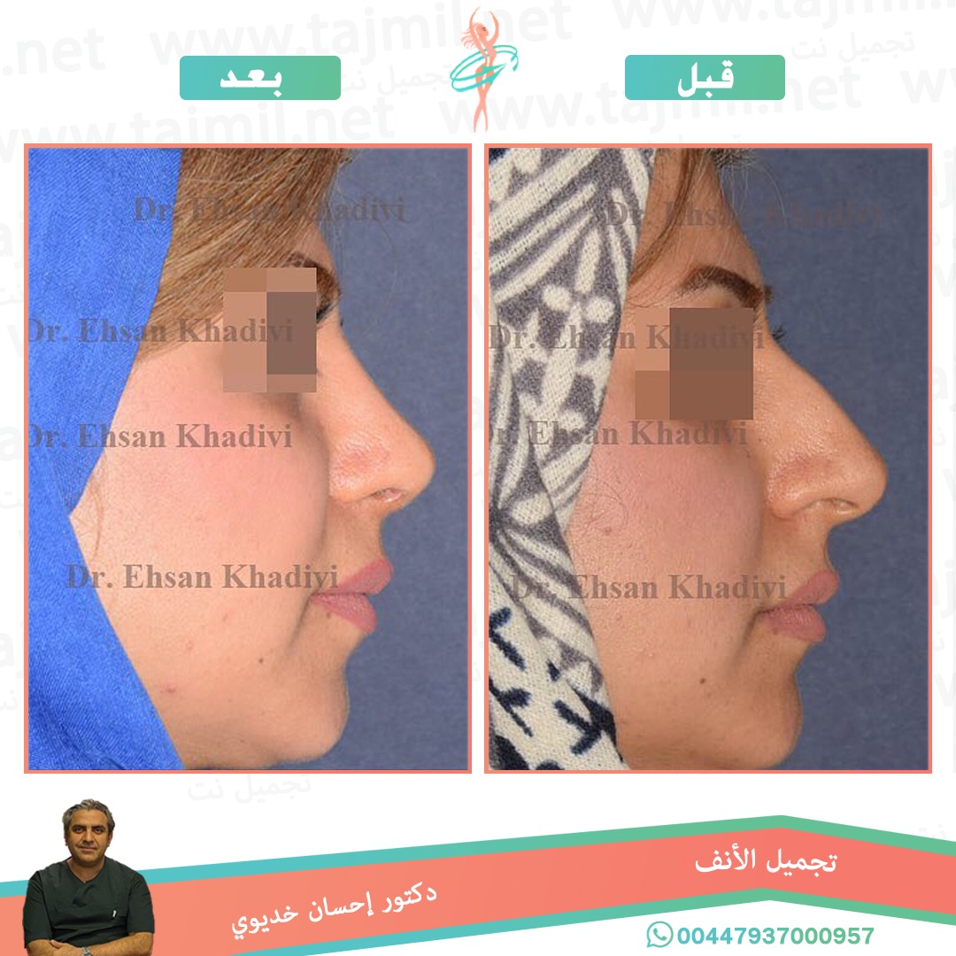  - دکتور إحسان خدیوي عملية تجميل الانف في ايران مع تجميل نت