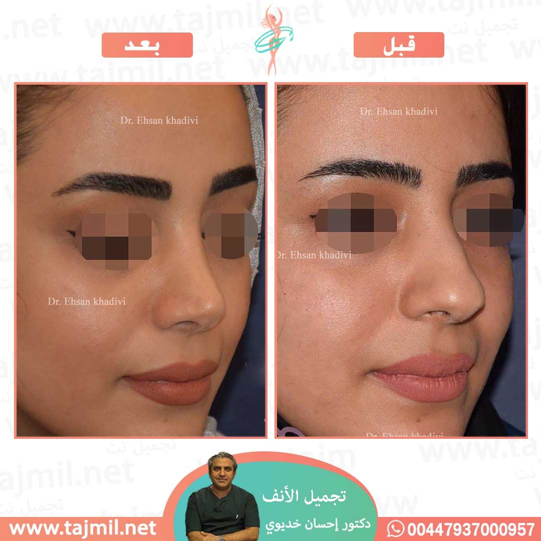  - دکتور إحسان خدیوي عملية تجميل الانف في ايران مع تجميل نت