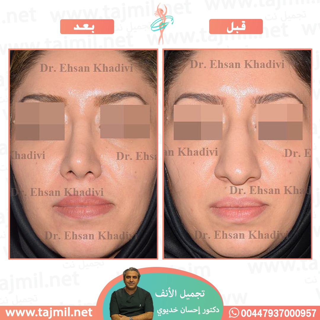  - دکتور إحسان خدیوي عملية تجميل الانف في ايران مع تجميل نت