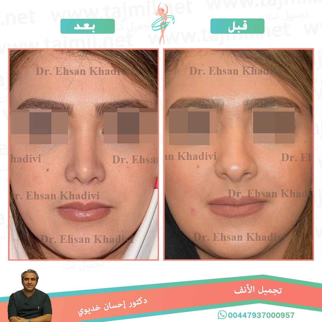  - دکتور إحسان خدیوي عملية تجميل الانف في ايران مع تجميل نت