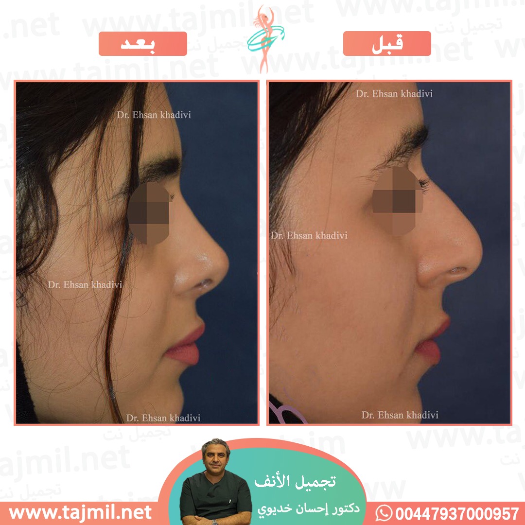  - دکتور إحسان خدیوي عملية تجميل الانف في ايران مع تجميل نت