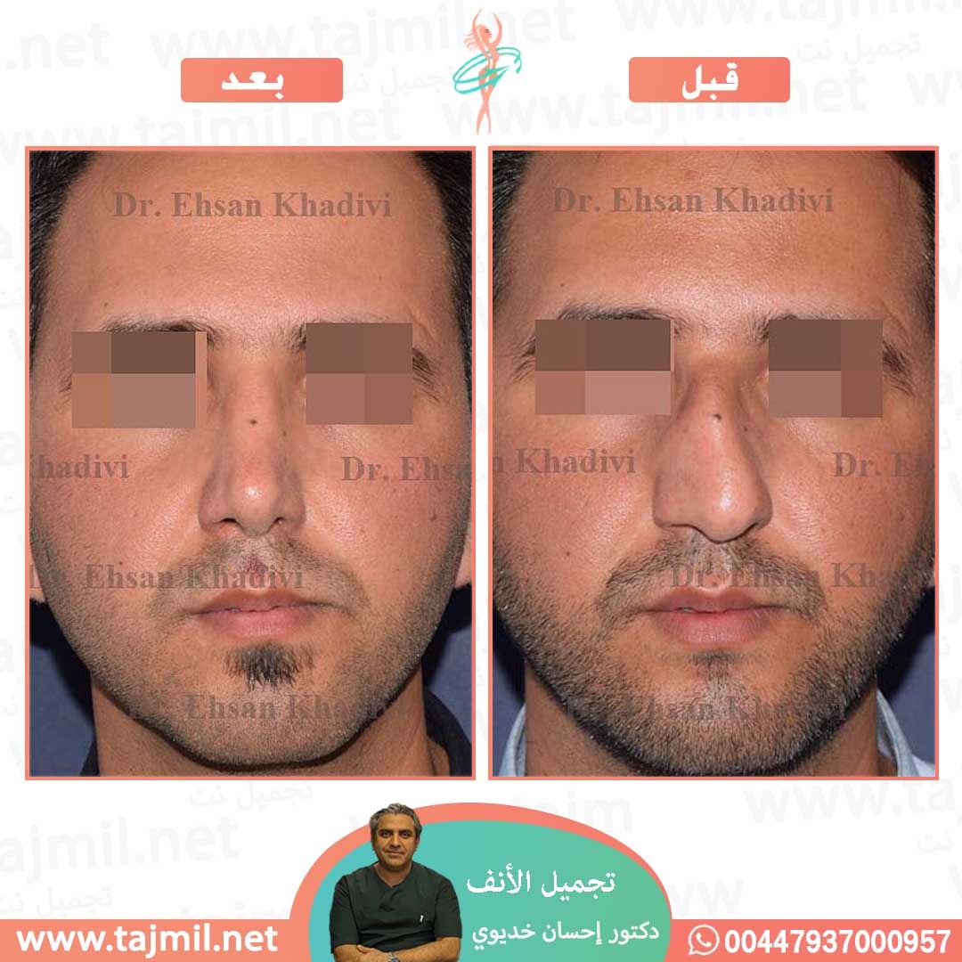  - دکتور إحسان خدیوي عملية تجميل الانف في ايران مع تجميل نت