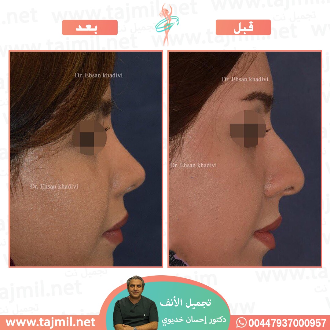  - دکتور إحسان خدیوي عملية تجميل الانف في ايران مع تجميل نت