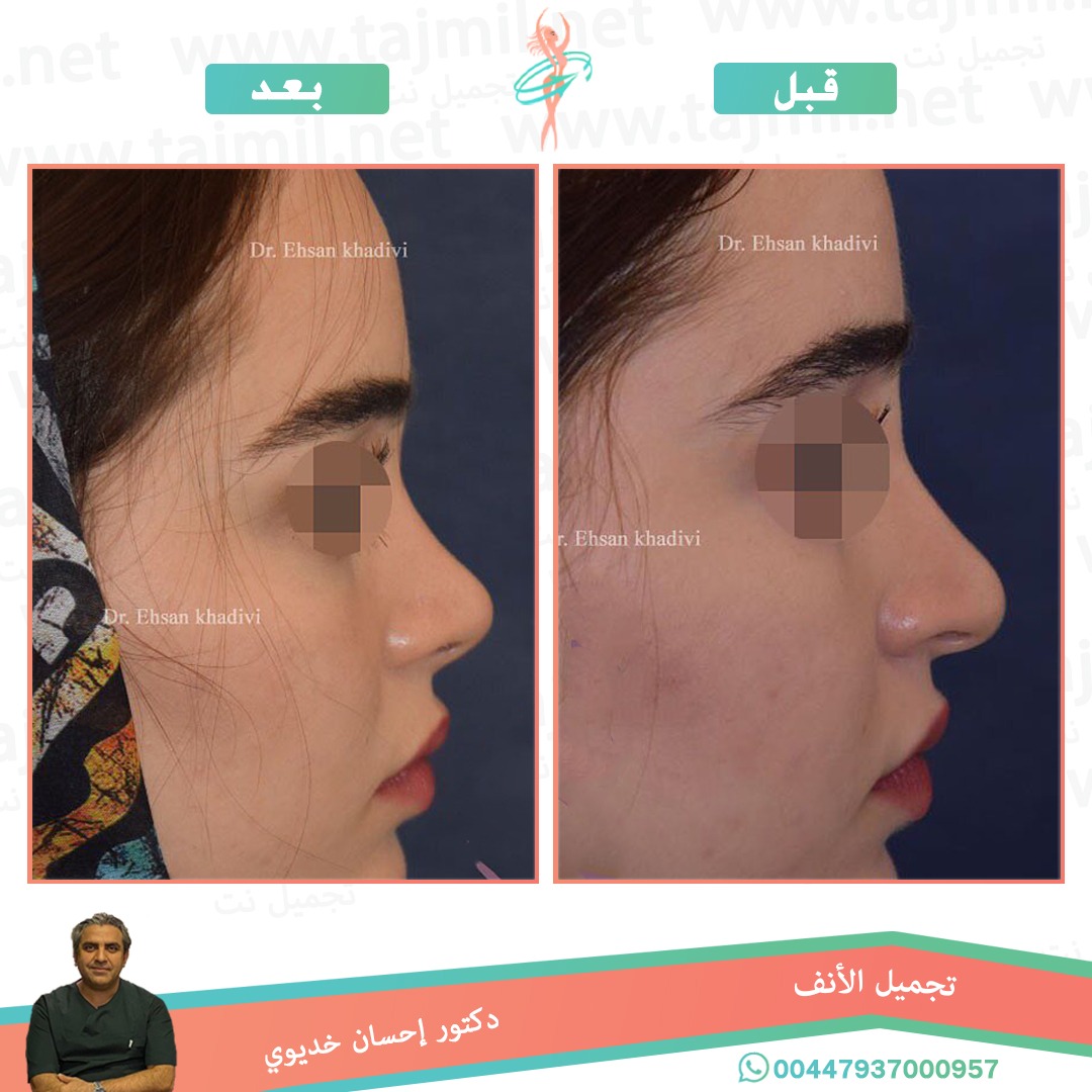  - دکتور إحسان خدیوي عملية تجميل الانف في ايران مع تجميل نت