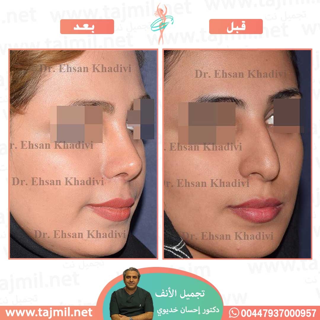  - دکتور إحسان خدیوي عملية تجميل الانف في ايران مع تجميل نت