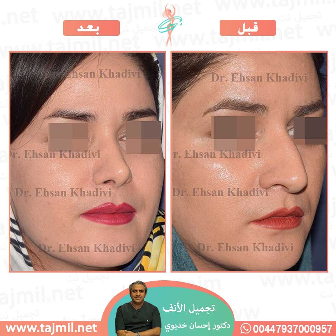  - دکتور إحسان خدیوي عملية تجميل الانف في ايران مع تجميل نت