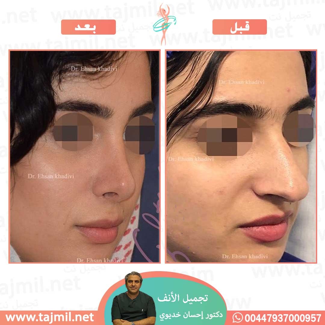  - دکتور إحسان خدیوي عملية تجميل الانف في ايران مع تجميل نت