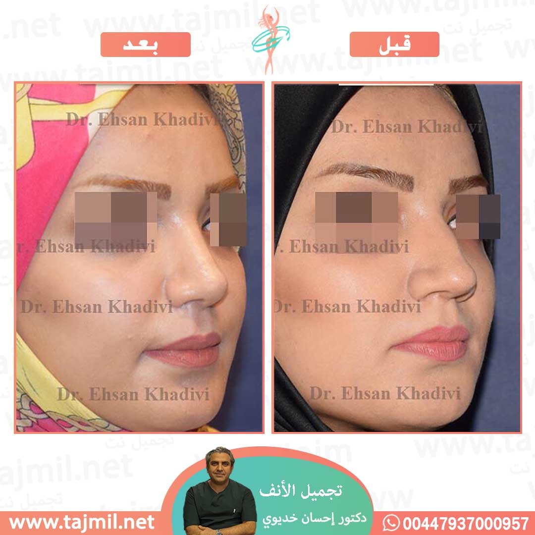  - دکتور إحسان خدیوي عملية تجميل الانف في ايران مع تجميل نت