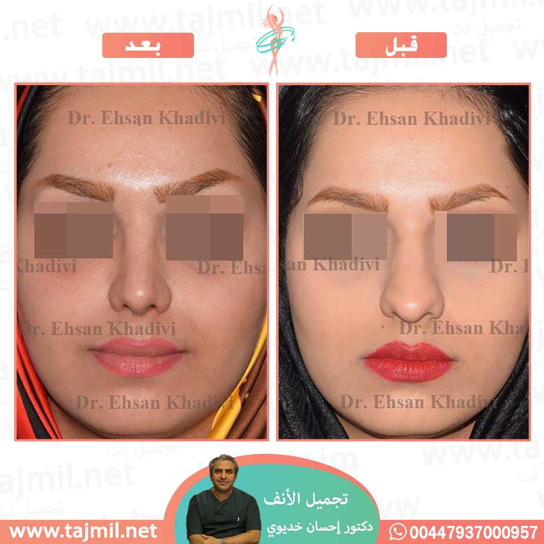  - دکتور إحسان خدیوي عملية تجميل الانف في ايران مع تجميل نت