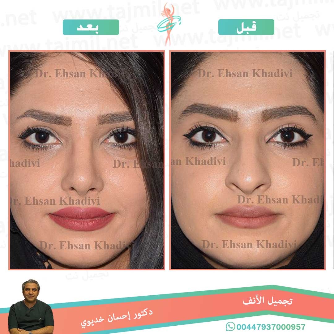  - دکتور إحسان خدیوي عملية تجميل الانف في ايران مع تجميل نت