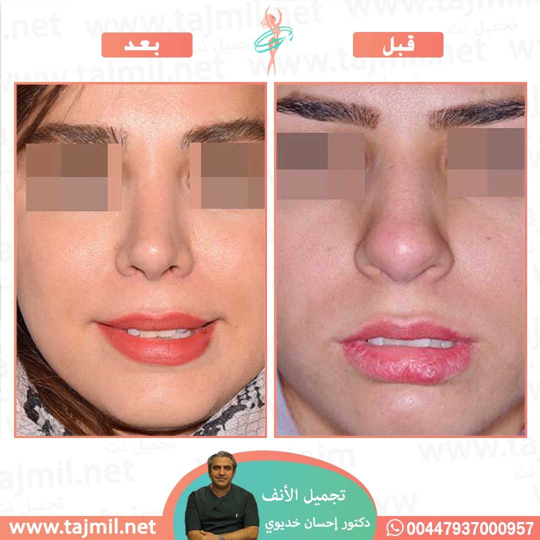  - دکتور إحسان خدیوي عملية تجميل الانف في ايران مع تجميل نت