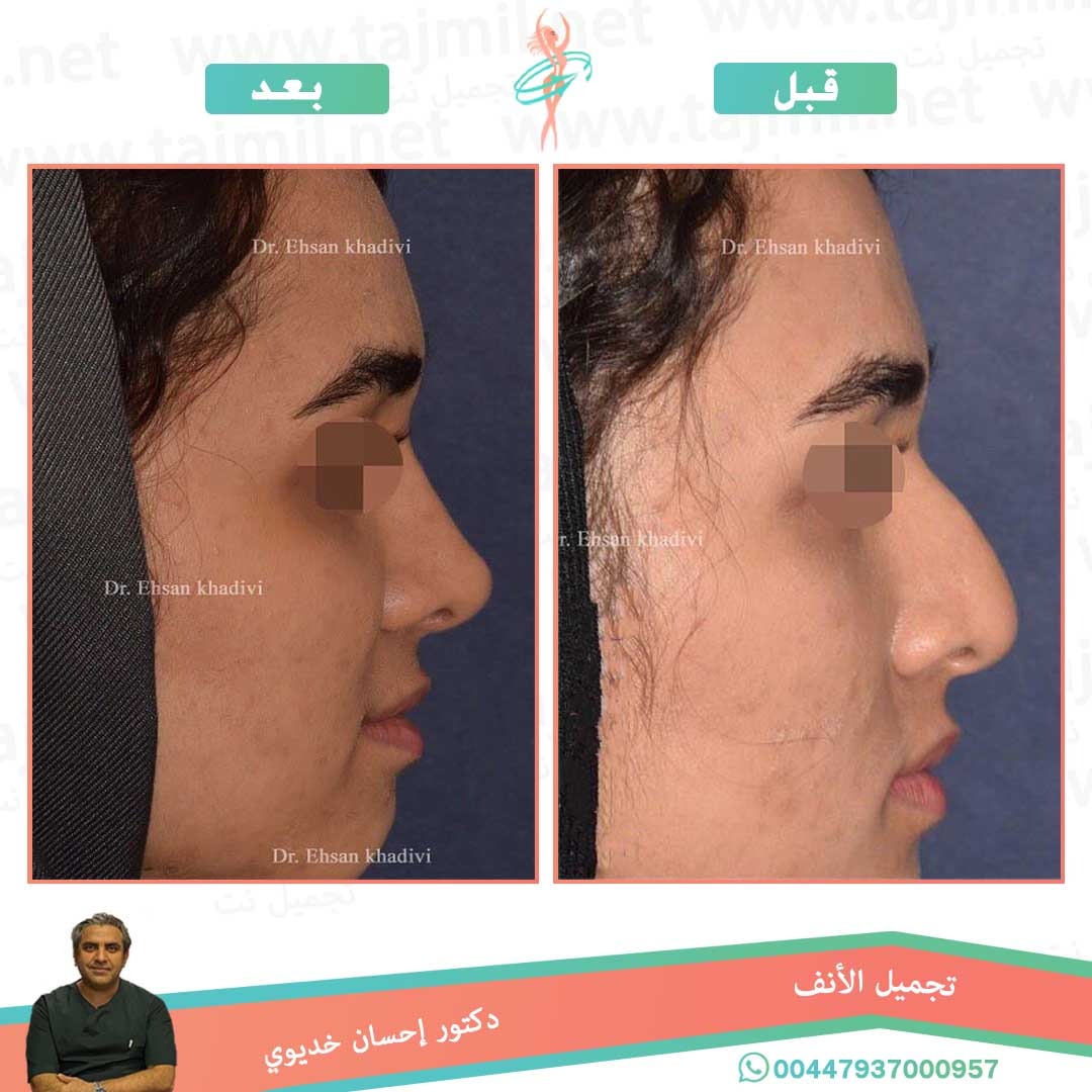  - دکتور إحسان خدیوي عملية تجميل الانف في ايران مع تجميل نت