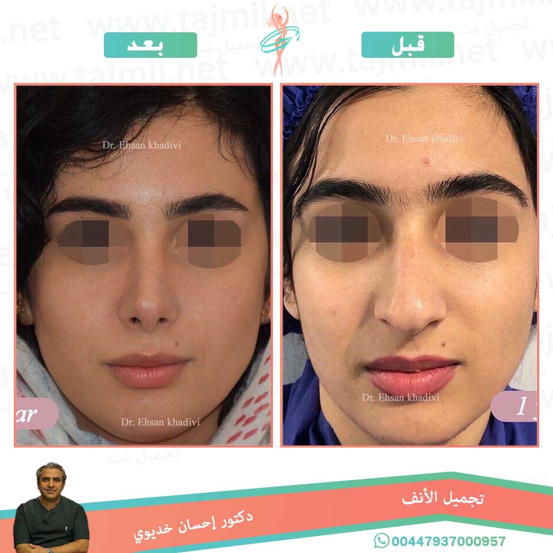  - دکتور إحسان خدیوي عملية تجميل الانف في ايران مع تجميل نت