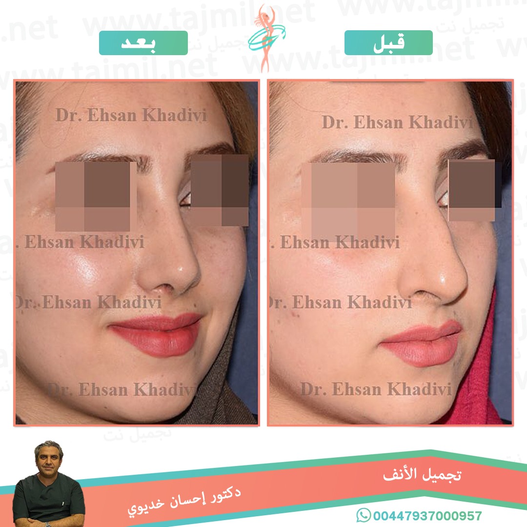  - دکتور إحسان خدیوي عملية تجميل الانف في ايران مع تجميل نت