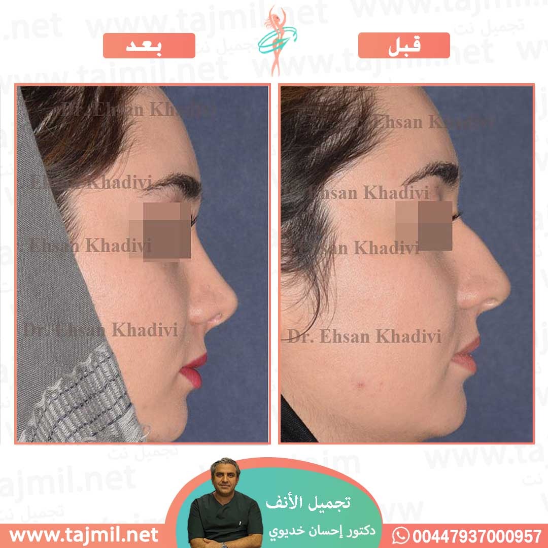  - دکتور إحسان خدیوي عملية تجميل الانف في ايران مع تجميل نت