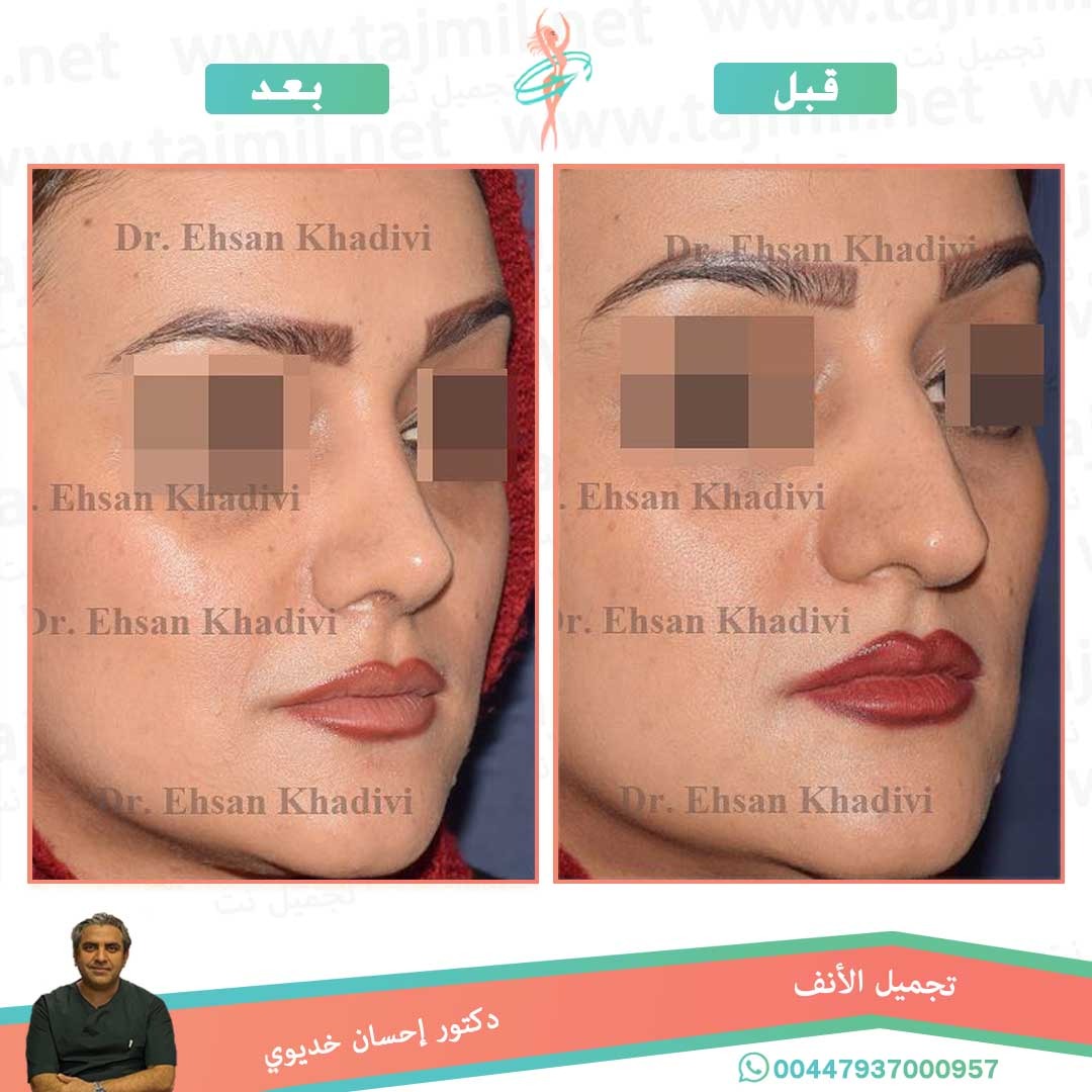  - دکتور إحسان خدیوي عملية تجميل الانف في ايران مع تجميل نت