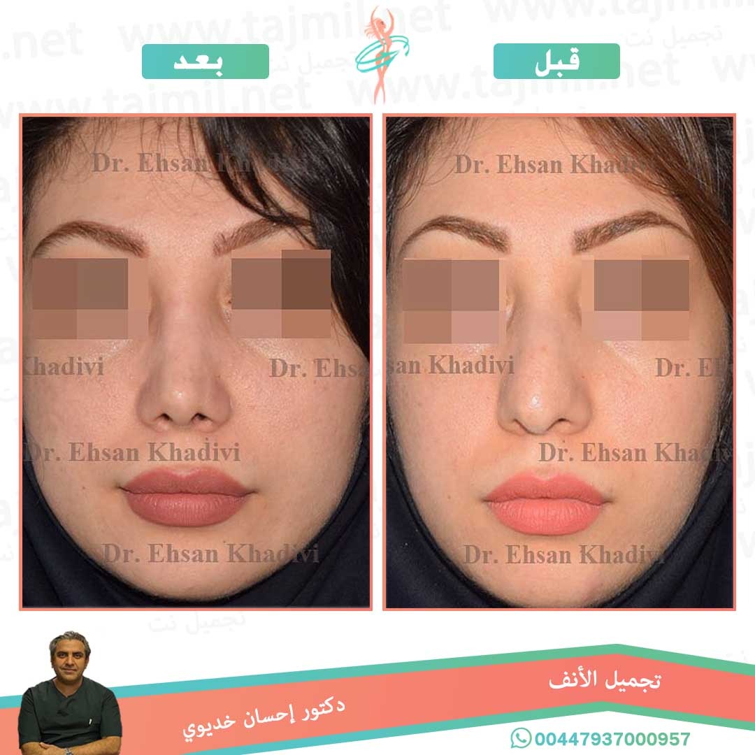  - دکتور إحسان خدیوي عملية تجميل الانف في ايران مع تجميل نت