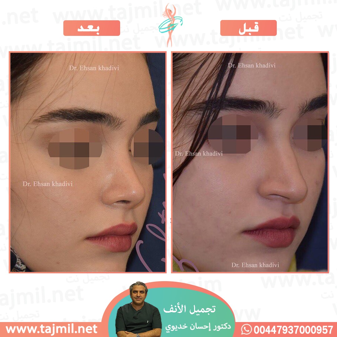  - دکتور إحسان خدیوي عملية تجميل الانف في ايران مع تجميل نت