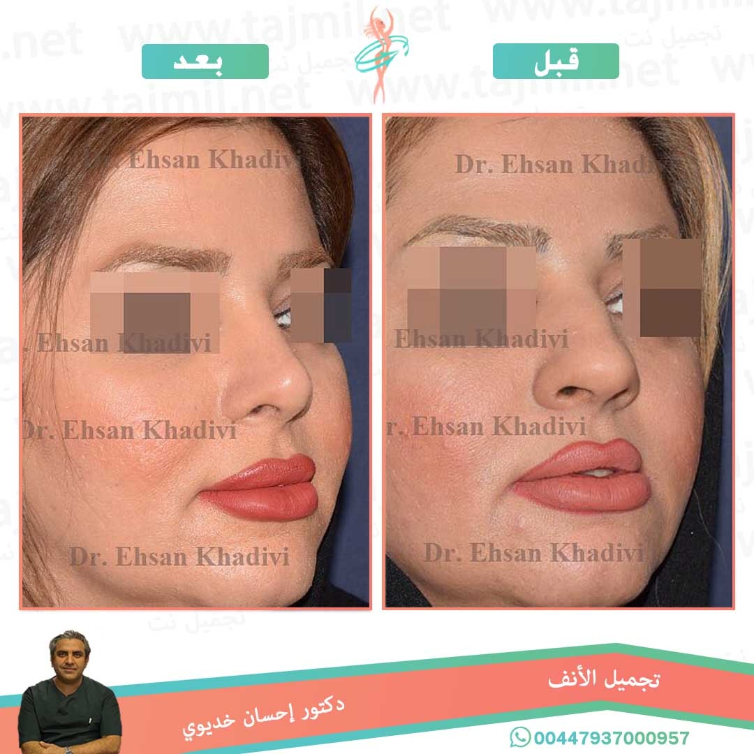  - دکتور إحسان خدیوي عملية تجميل الانف في ايران مع تجميل نت