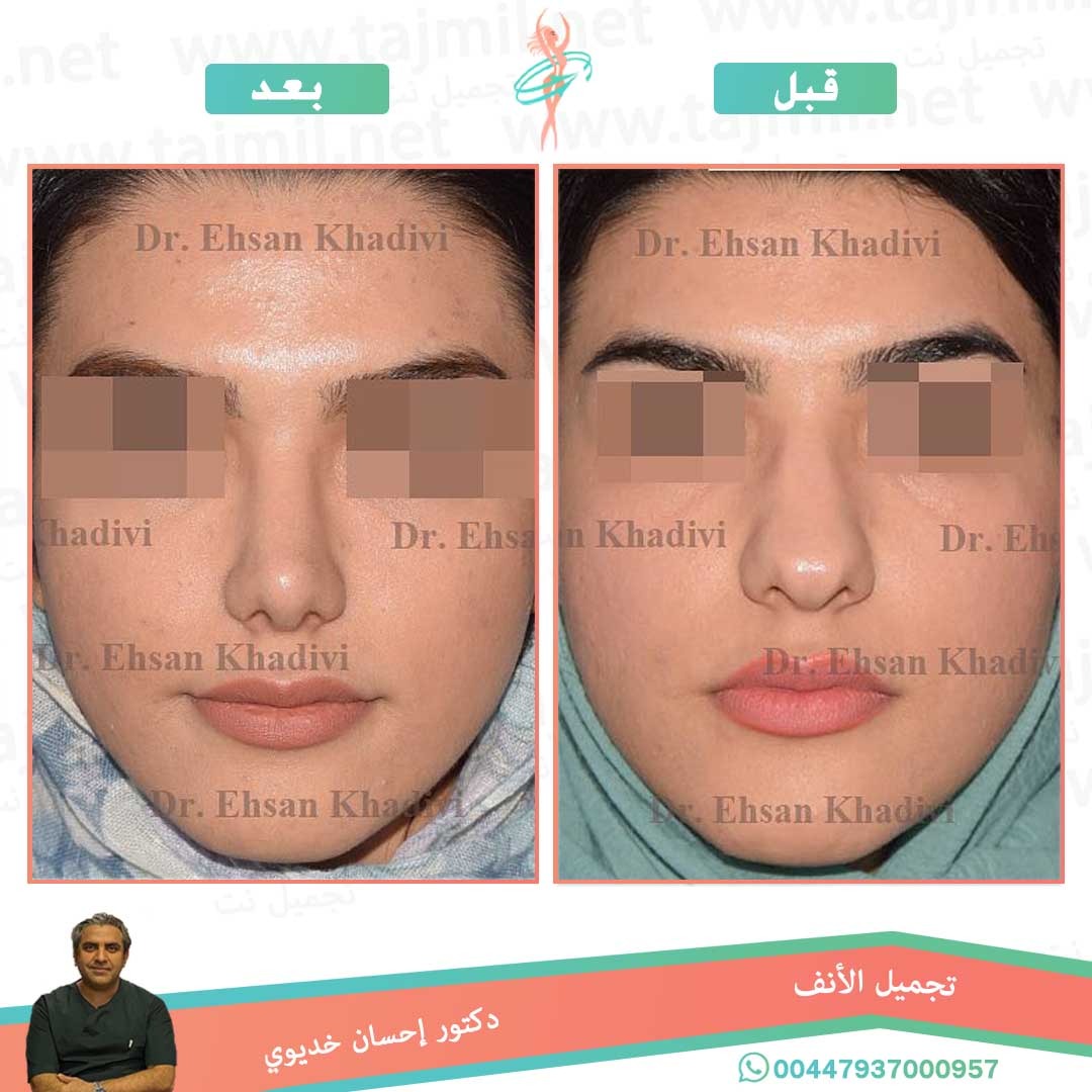  - دکتور إحسان خدیوي عملية تجميل الانف في ايران مع تجميل نت