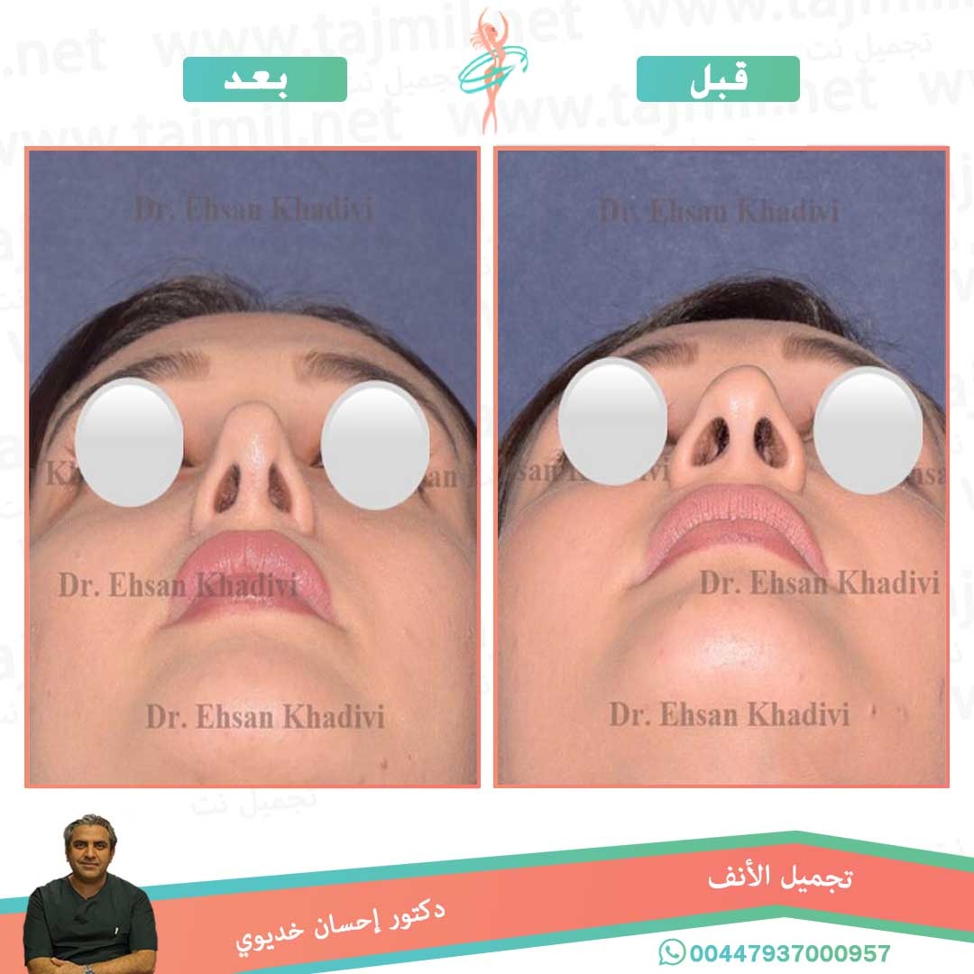  - دکتور إحسان خدیوي عملية تجميل الانف في ايران مع تجميل نت