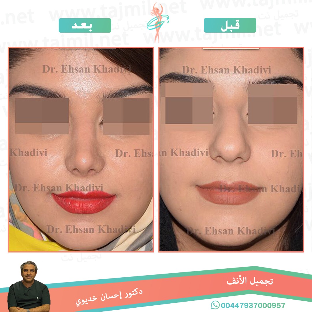  - دکتور إحسان خدیوي عملية تجميل الانف في ايران مع تجميل نت