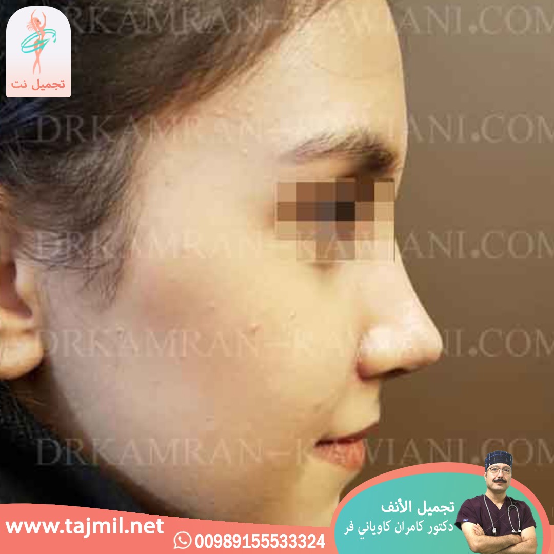  - دکتور کامران کاویاني فر عملية تجميل الانف في ايران مع تجميل نت