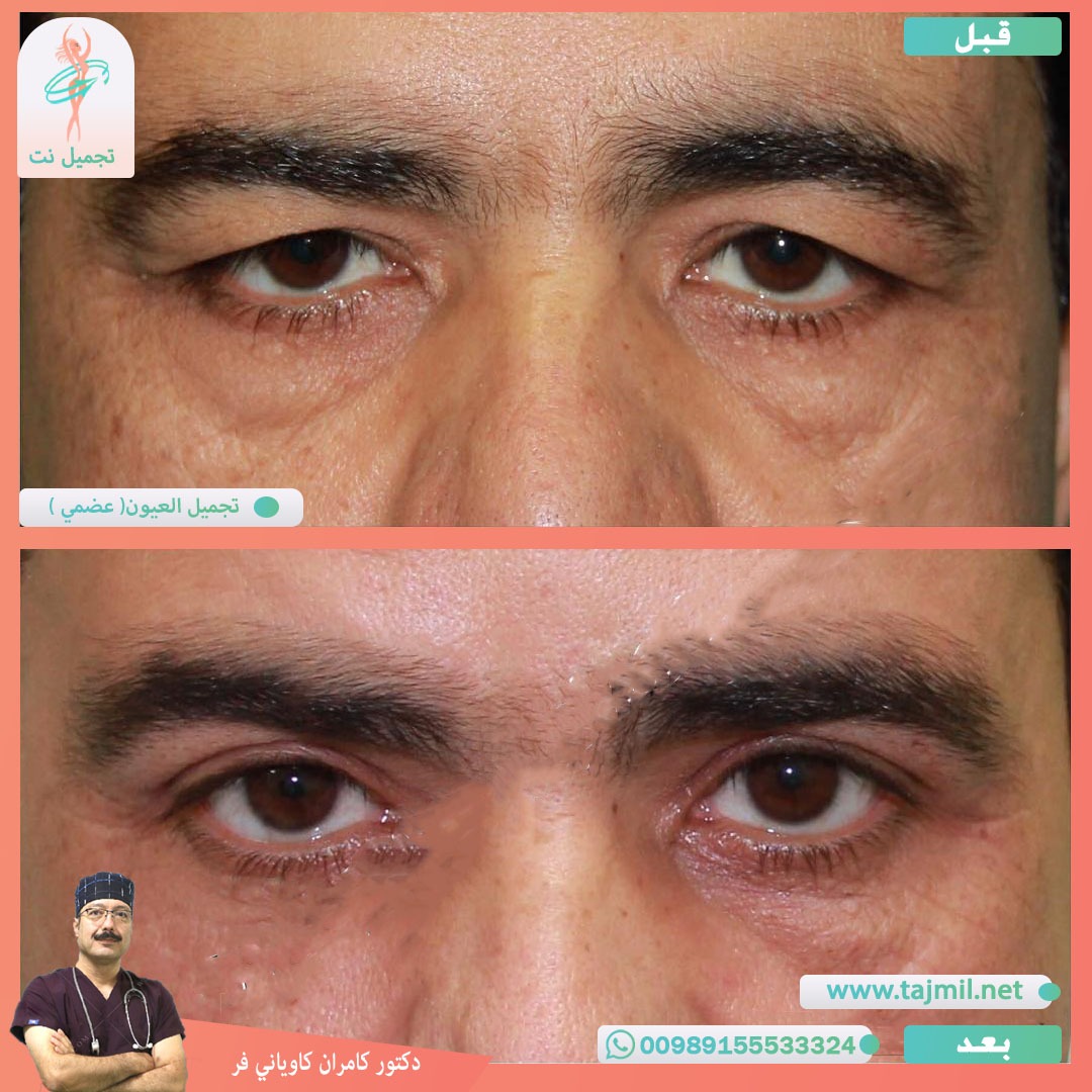  - دکتور کامران کاویاني فرعملية شد الأجفان في ايران مع تجميل نت