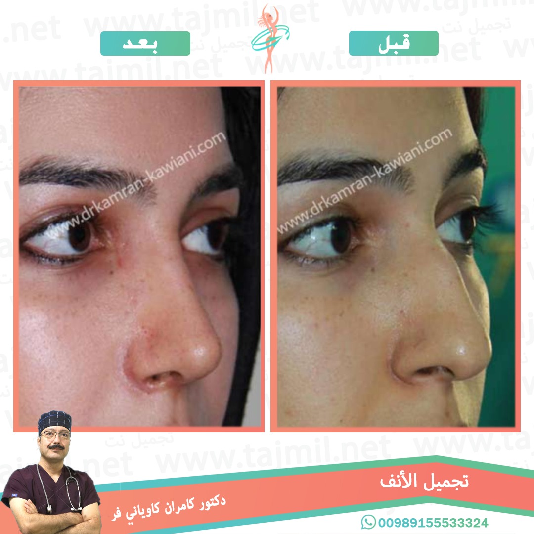  - دکتور کامران کاویاني فر عملية تجميل الانف في ايران مع تجميل نت