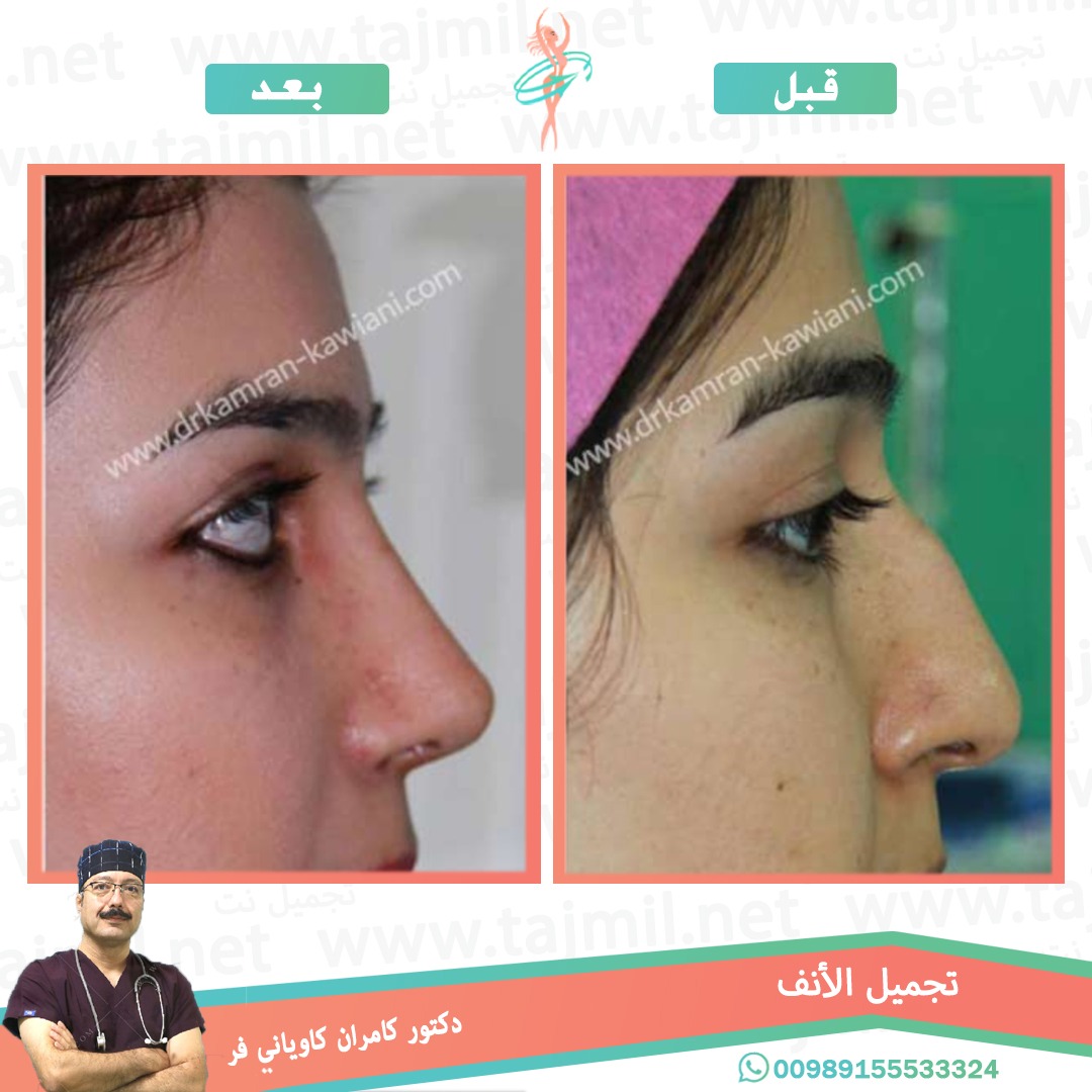  - دکتور کامران کاویاني فر عملية تجميل الانف في ايران مع تجميل نت