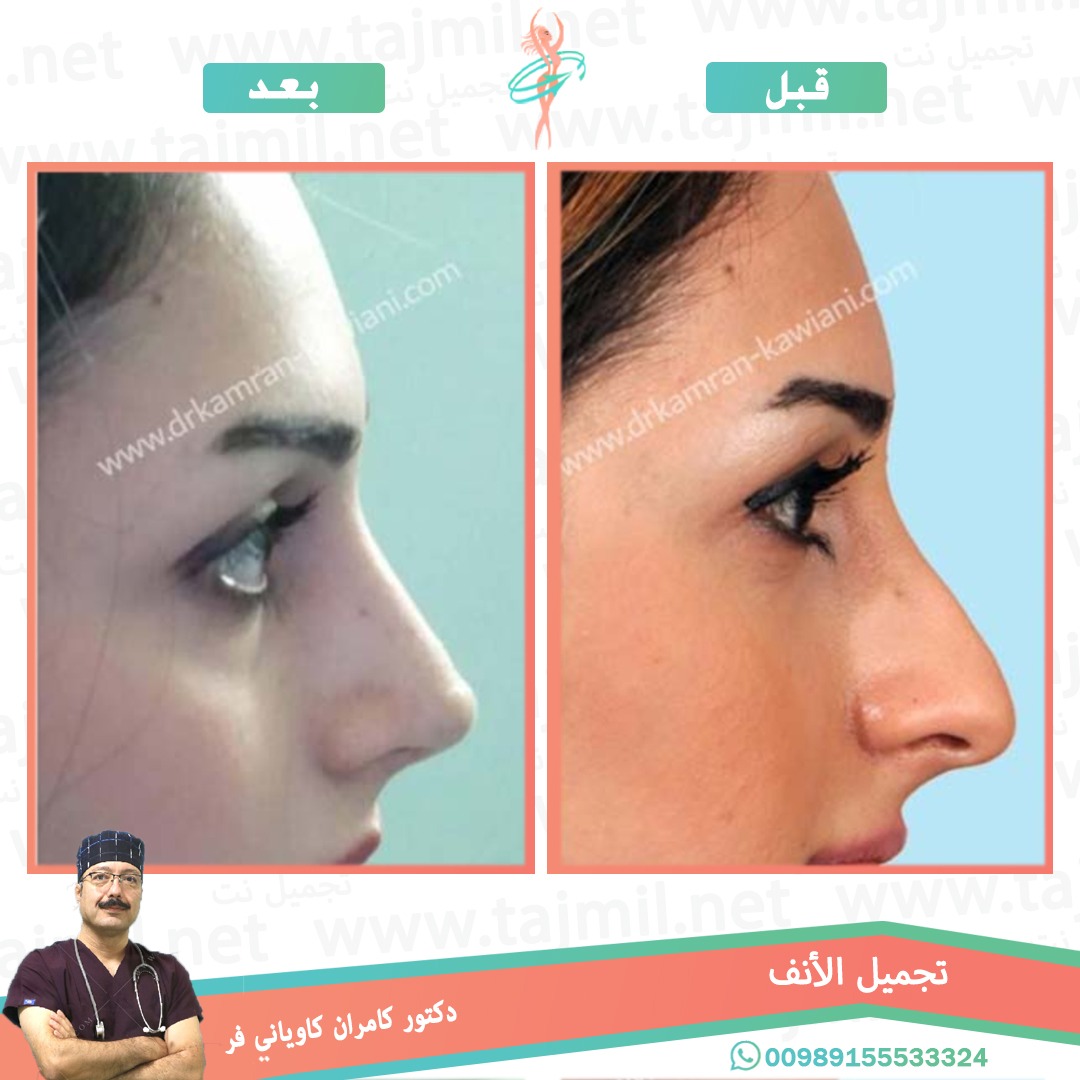  - دکتور کامران کاویاني فر عملية تجميل الانف في ايران مع تجميل نت