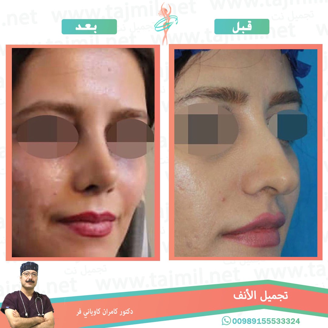  - دکتور کامران کاویاني فر عملية تجميل الانف في ايران مع تجميل نت