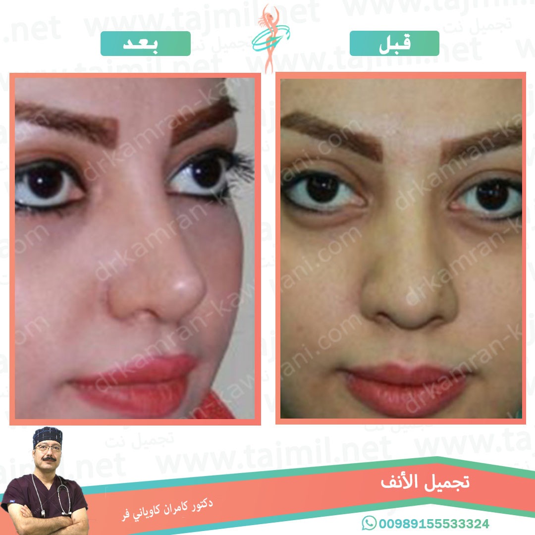  - دکتور کامران کاویاني فر عملية تجميل الانف في ايران مع تجميل نت