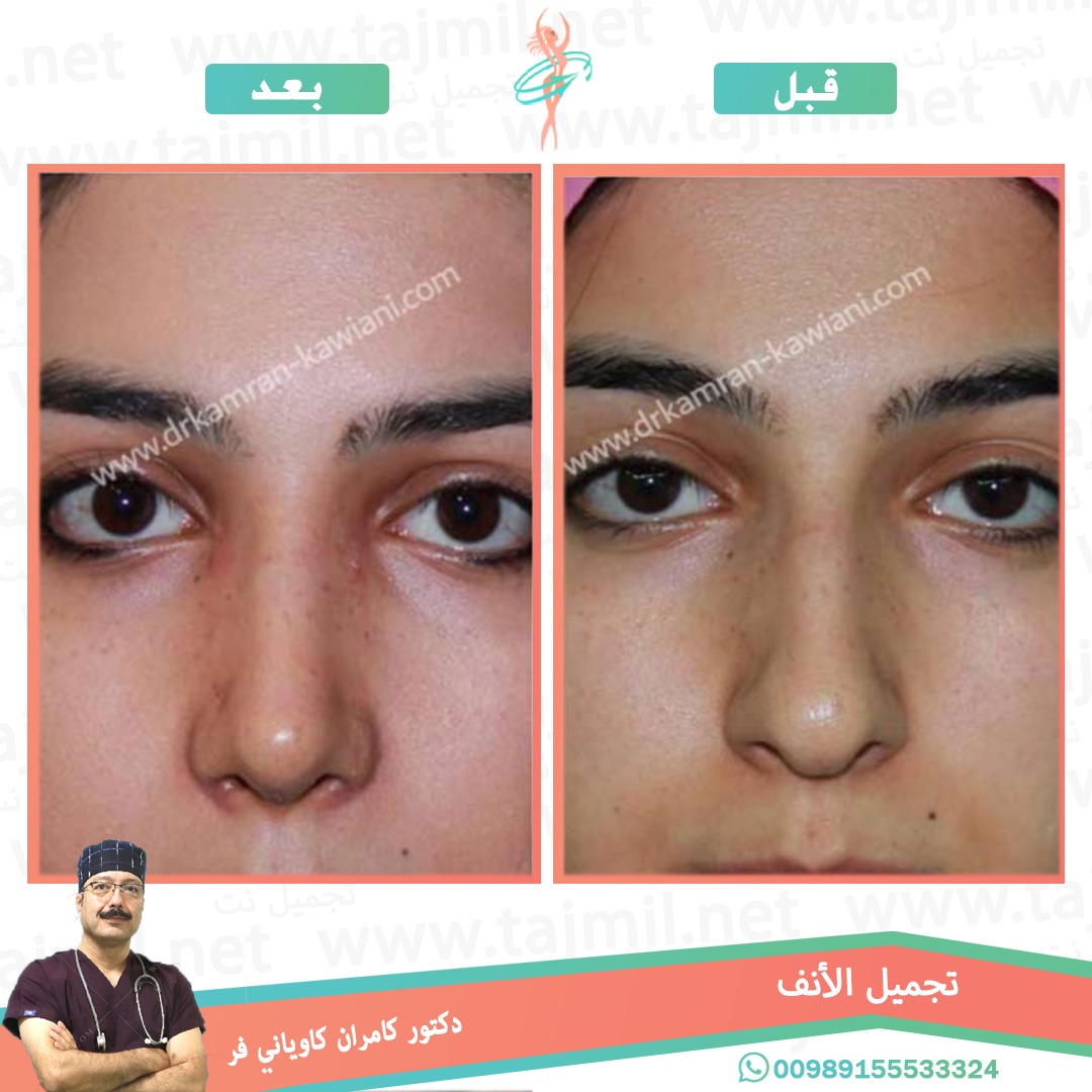  - دکتور کامران کاویاني فر عملية تجميل الانف في ايران مع تجميل نت