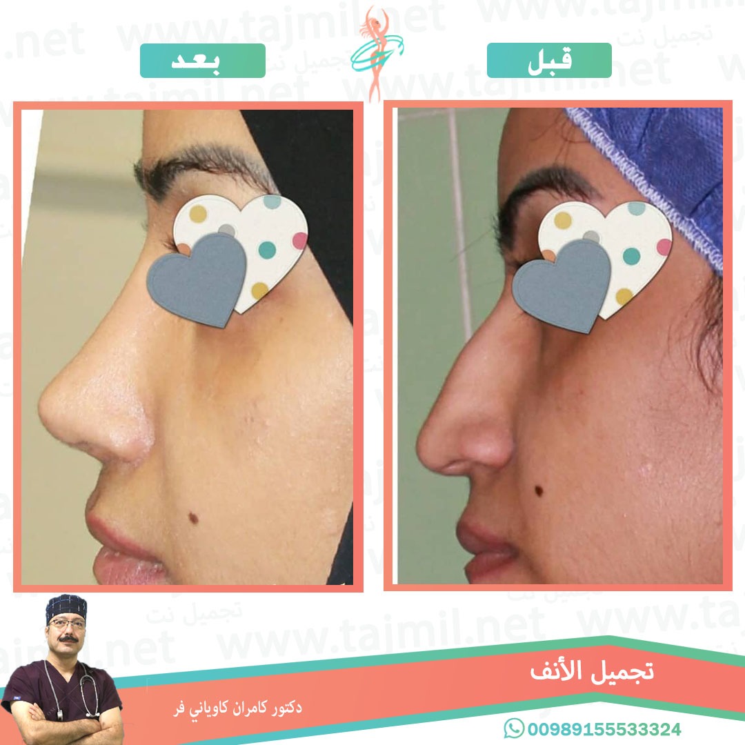  - دکتور کامران کاویاني فرعملية تجميل الانف في ايران مع تجميل نت