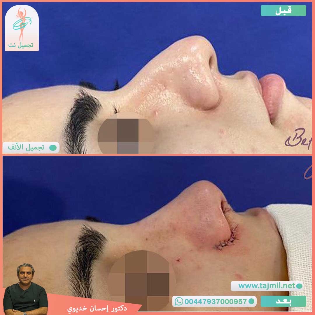  - دکتور إحسان خدیوي عملية تجميل الانف في ايران مع تجميل نت