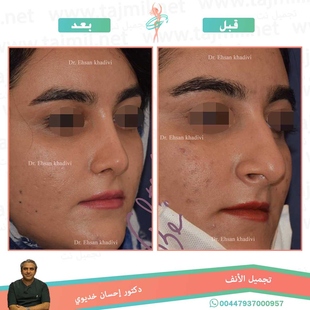  - دکتور إحسان خدیوي عملية تجميل الانف في ايران مع تجميل نت