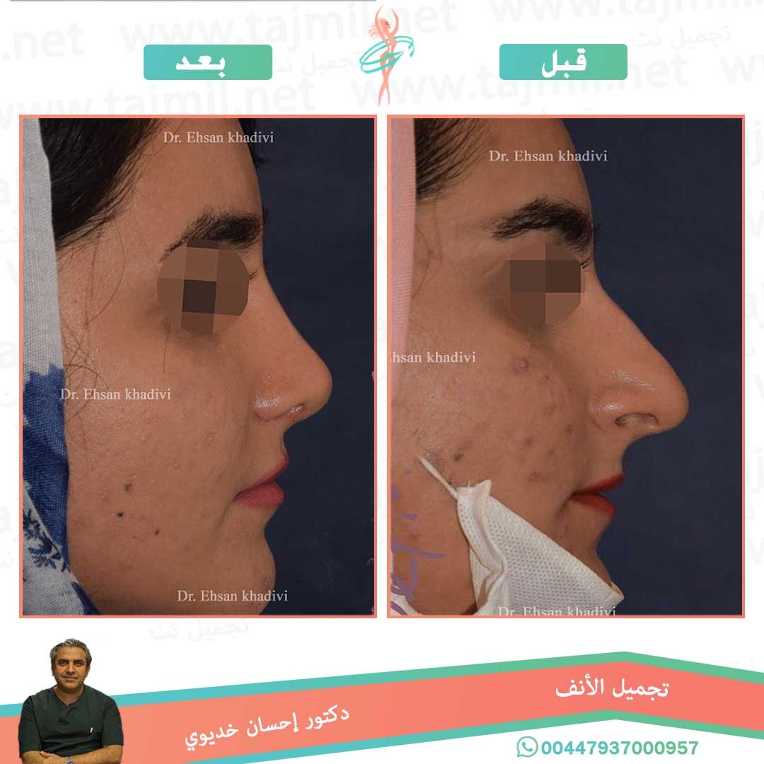  - دکتور إحسان خدیوي عملية تجميل الانف في ايران مع تجميل نت