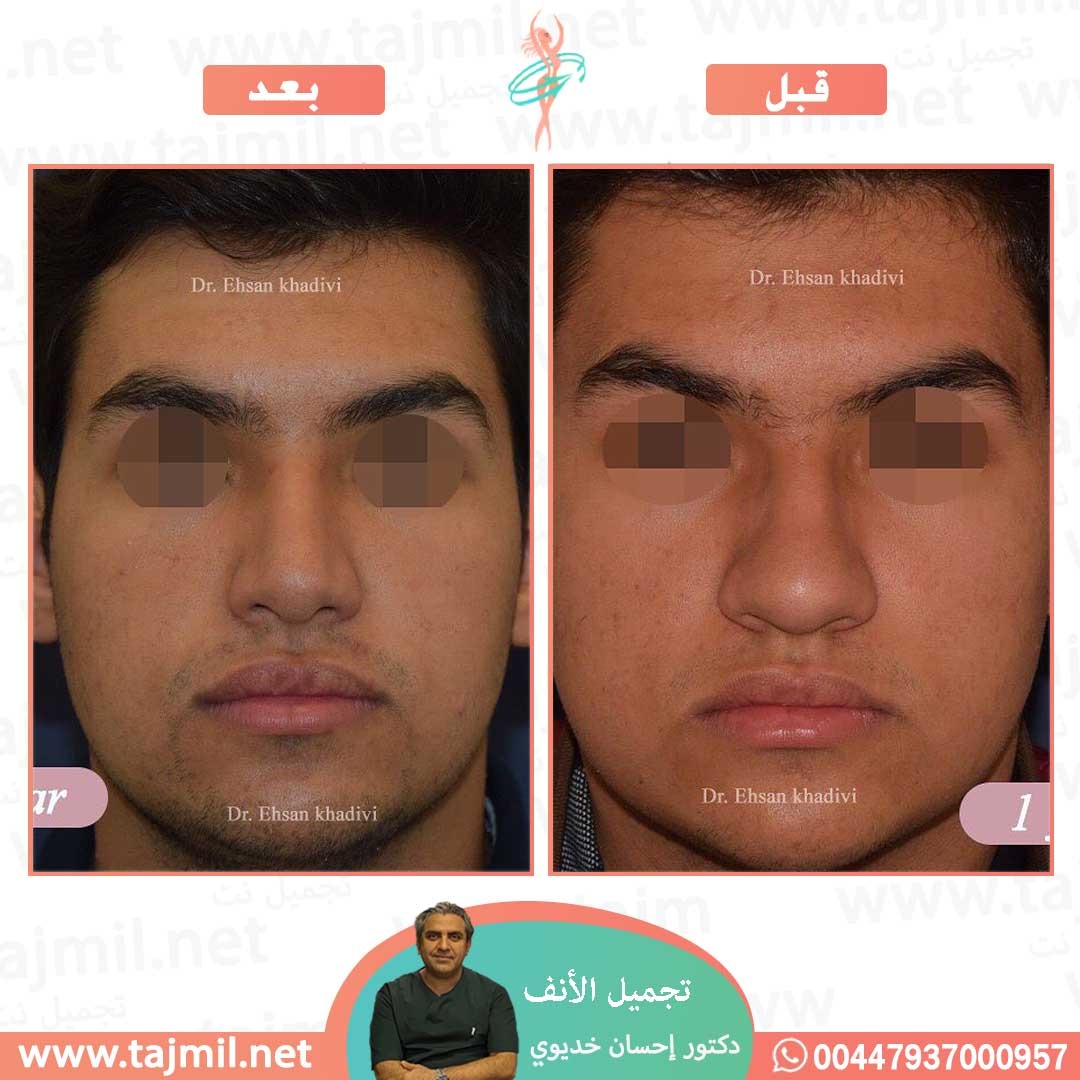  - دکتور إحسان خدیوي عملية تجميل الانف في ايران مع تجميل نت