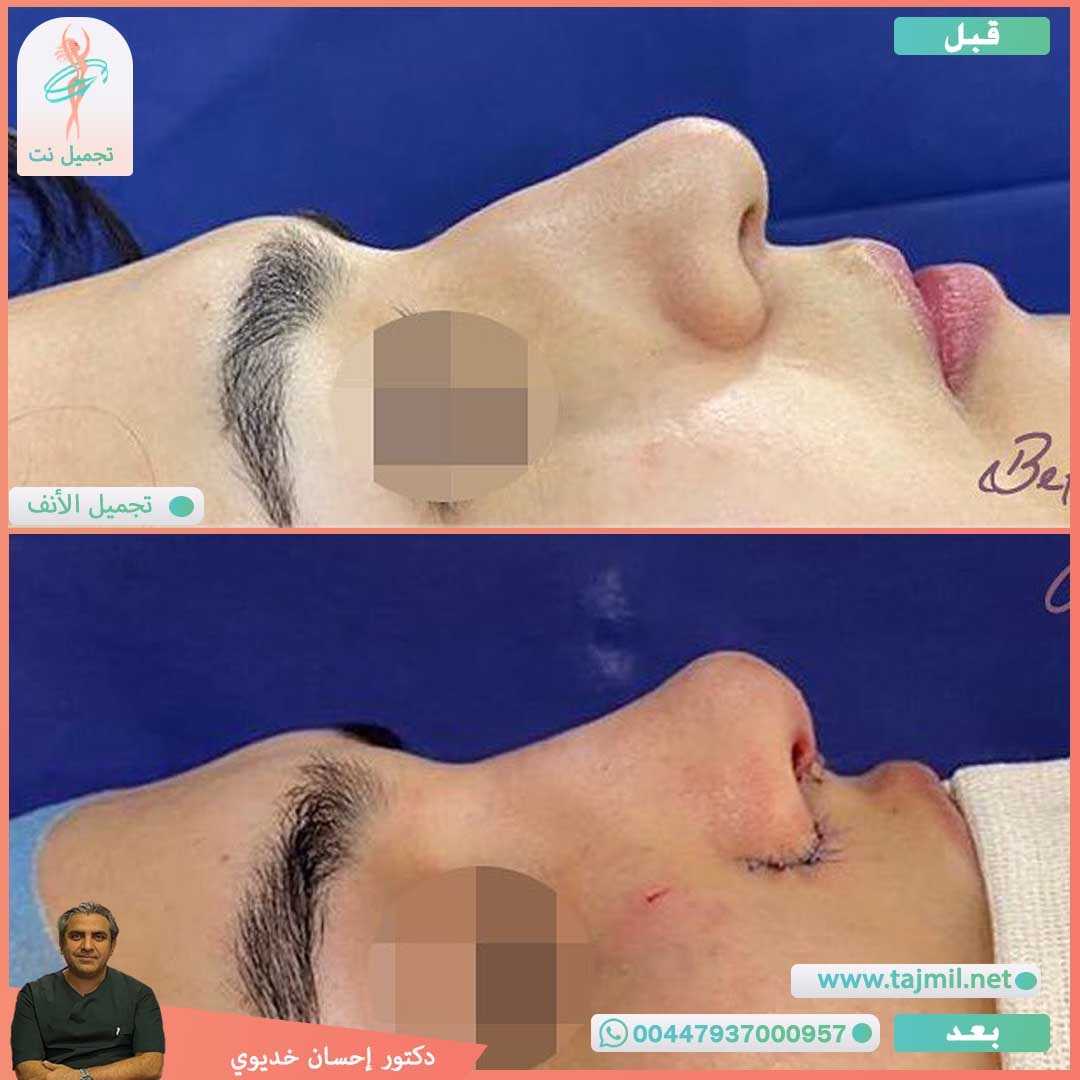  - دکتور إحسان خدیوي عملية تجميل الانف في ايران مع تجميل نت