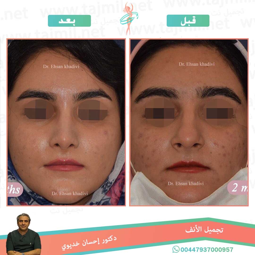  - دکتور إحسان خدیوي عملية تجميل الانف في ايران مع تجميل نت