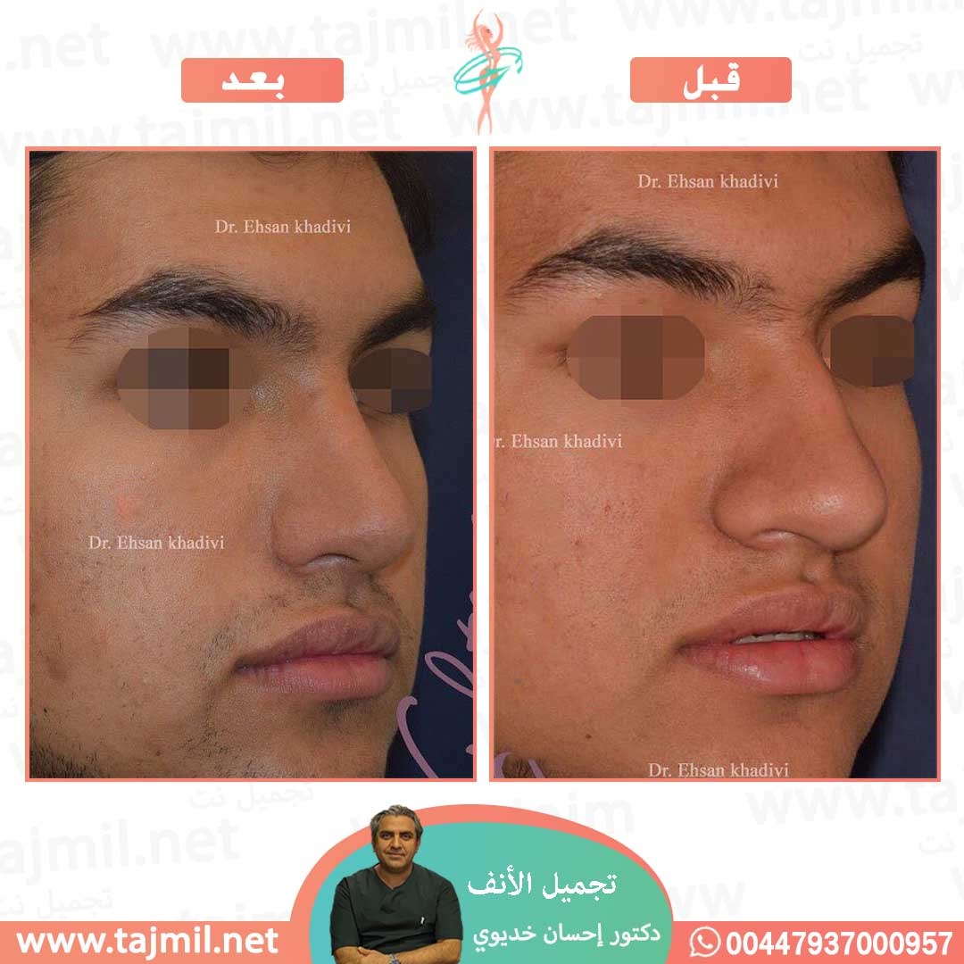  - دکتور إحسان خدیوي عملية تجميل الانف في ايران مع تجميل نت