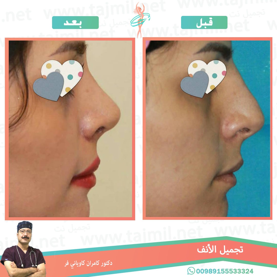  - دکتور کامران کاویاني فرعملية تجميل الانف في ايران مع تجميل نت